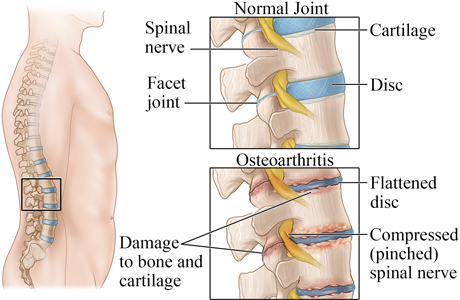 Normal spine and osteoarthritis of the spine