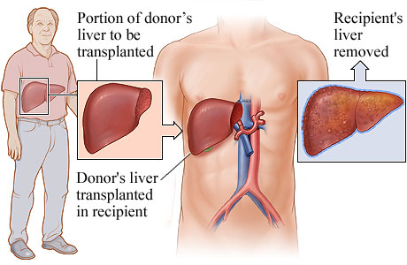 Living-donor liver transplant.