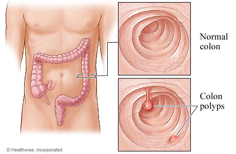 Colon polyps and the location of the colon
