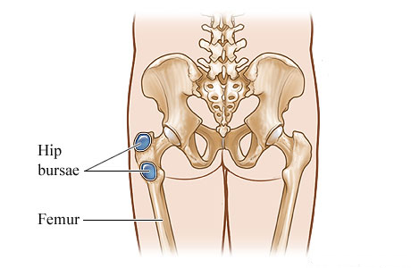 Bursitis of the hip