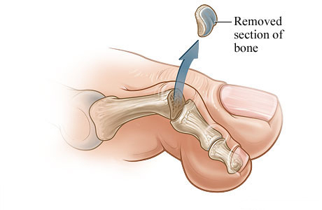 The bone section that is removed