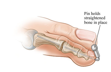 Pin holding the straightened bone in place