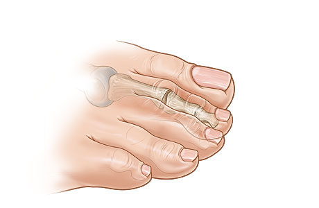 Straightened toe after pin is removed