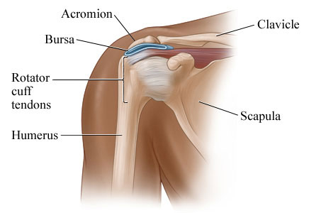 Bursitis of the shoulder