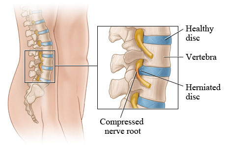 Picture of a herniated disc (side view)