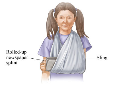 How to wear a splint or sling for an injured arm