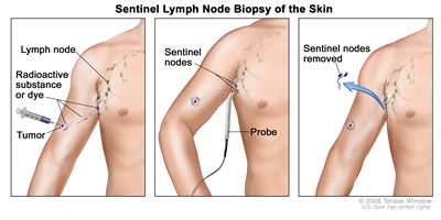 Sentinel lymph node biopsy of the skin. The first of three panels shows a radioactive substance and/or blue dye injected near the tumor; the middle panel shows that the injected material is followed visually and/or with a probe that detects radioactivity to find the sentinel nodes (the first lymph nodes to take up the material); the third panel shows the removal of the tumor and the sentinel nodes to check for cancer cells.
